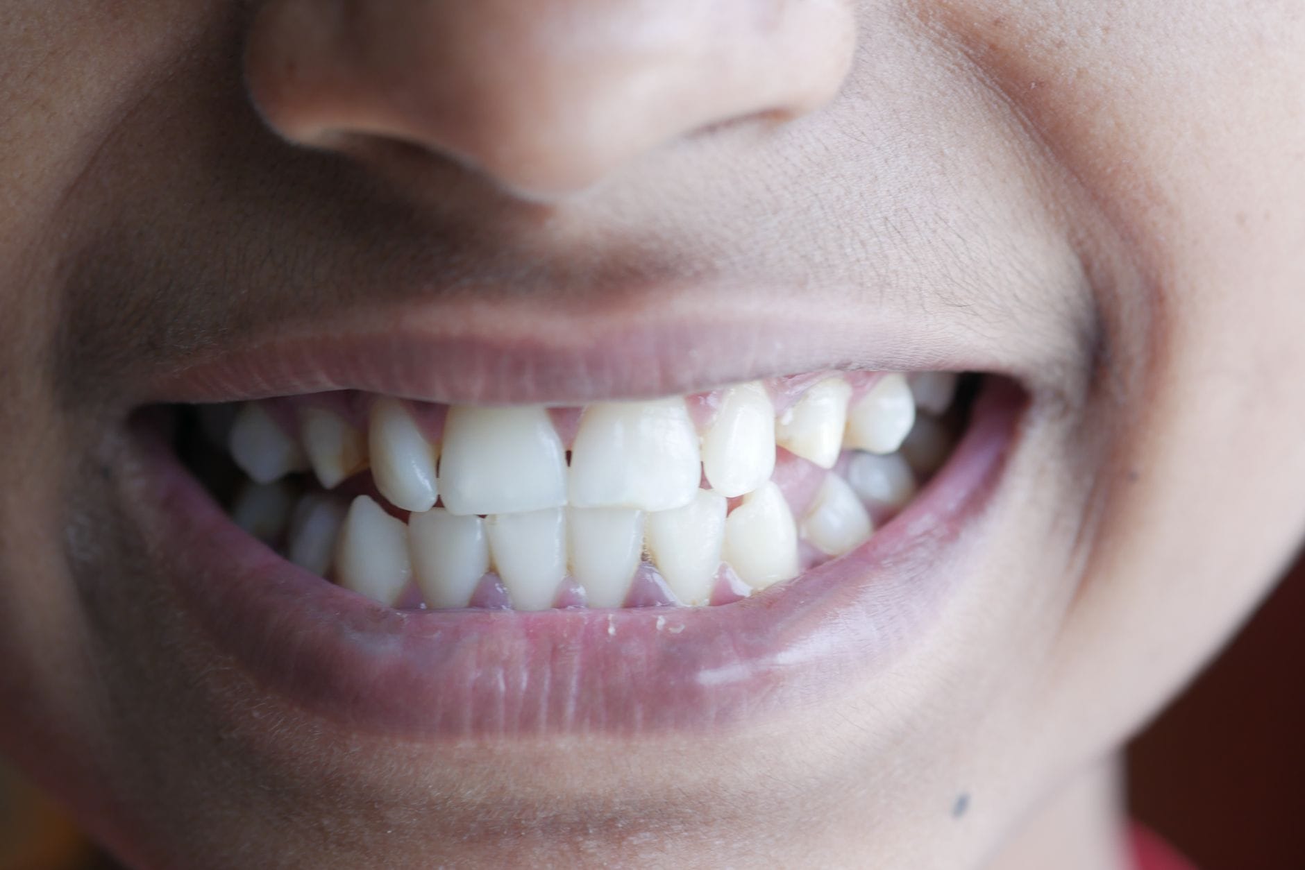 Close-up of a person smiling, showing upper and lower teeth and lips.